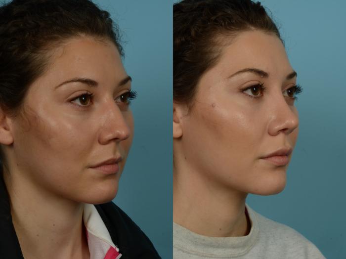 Before & After Rhinoplasty by Dr. Sinno Case 866 Right Oblique View in Chicago, IL