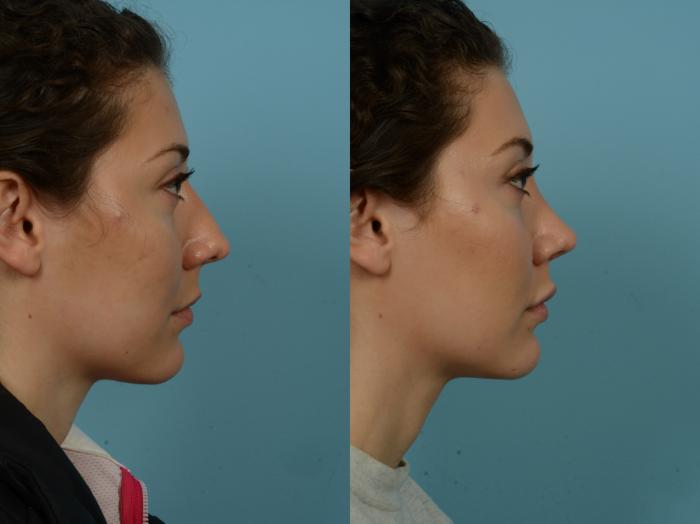 Before & After Rhinoplasty by Dr. Sinno Case 866 Right Side View in Chicago, IL