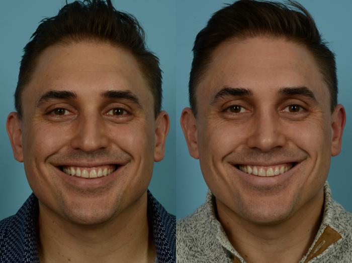 Before & After Rhinoplasty by Dr. Sinno Case 867 Front View in Chicago, IL