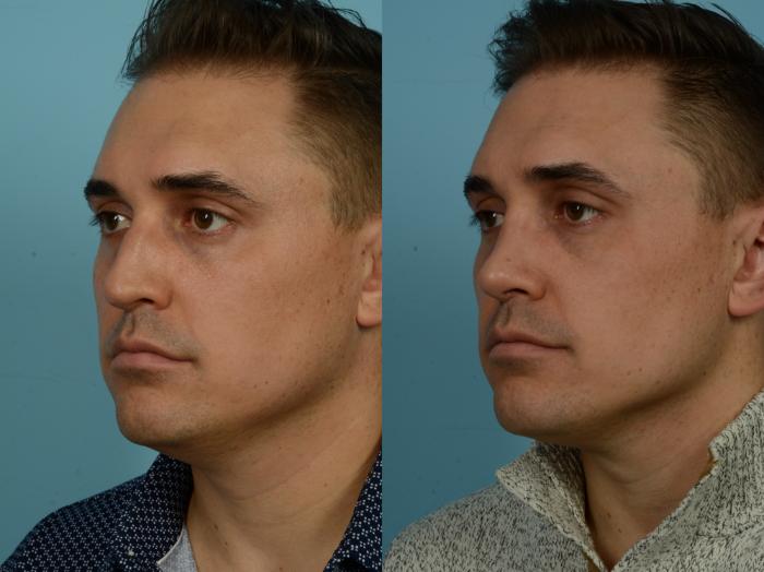 Before & After Rhinoplasty by Dr. Sinno Case 867 Left Oblique View in Chicago, IL