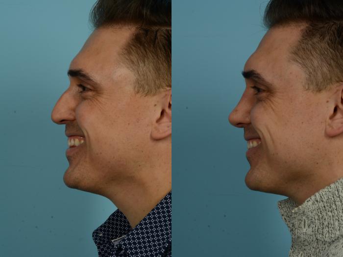 Before & After Rhinoplasty by Dr. Sinno Case 867 Left Side View in Chicago, IL