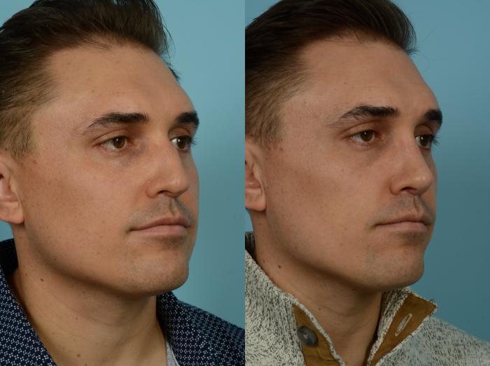 Before & After Rhinoplasty by Dr. Sinno Case 867 Right Oblique View in Chicago, IL