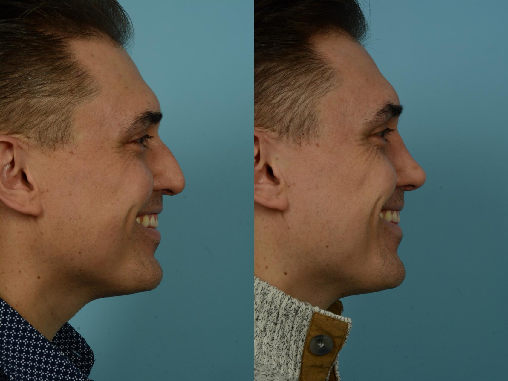 Before & After Rhinoplasty by Dr. Sinno Case 867 Right Side View in Chicago, IL