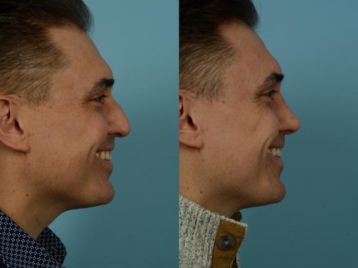 Before & After Rhinoplasty by Dr. Sinno Case 867 Right Side View in Chicago, IL
