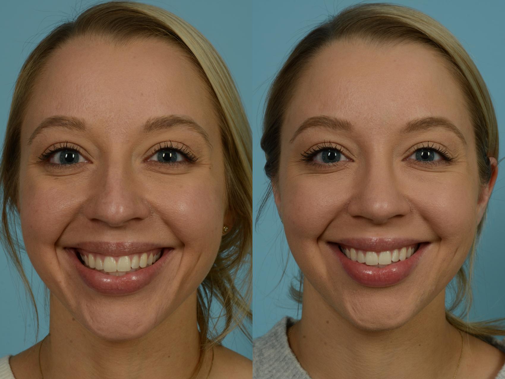 Before & After Rhinoplasty by Dr. Sinno Case 868 Front View in Chicago, IL