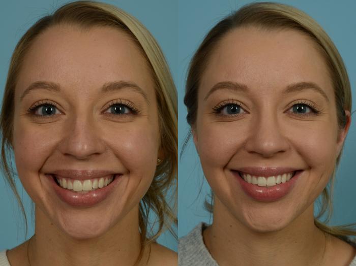 Before & After Rhinoplasty by Dr. Sinno Case 868 Front View in Chicago, IL