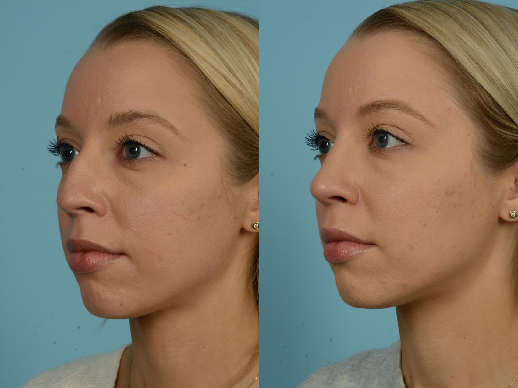 Before & After Rhinoplasty by Dr. Sinno Case 868 Left Oblique View in Chicago, IL
