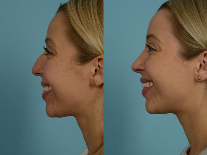 Before & After Rhinoplasty by Dr. Sinno Case 868 Left Side View in Chicago, IL