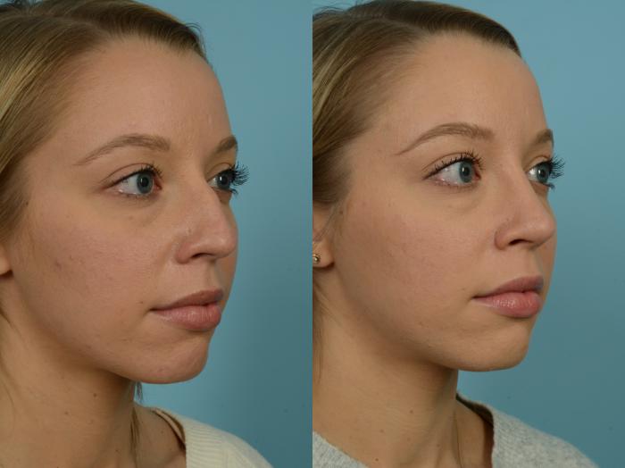 Before & After Rhinoplasty by Dr. Sinno Case 868 Right Oblique View in Chicago, IL
