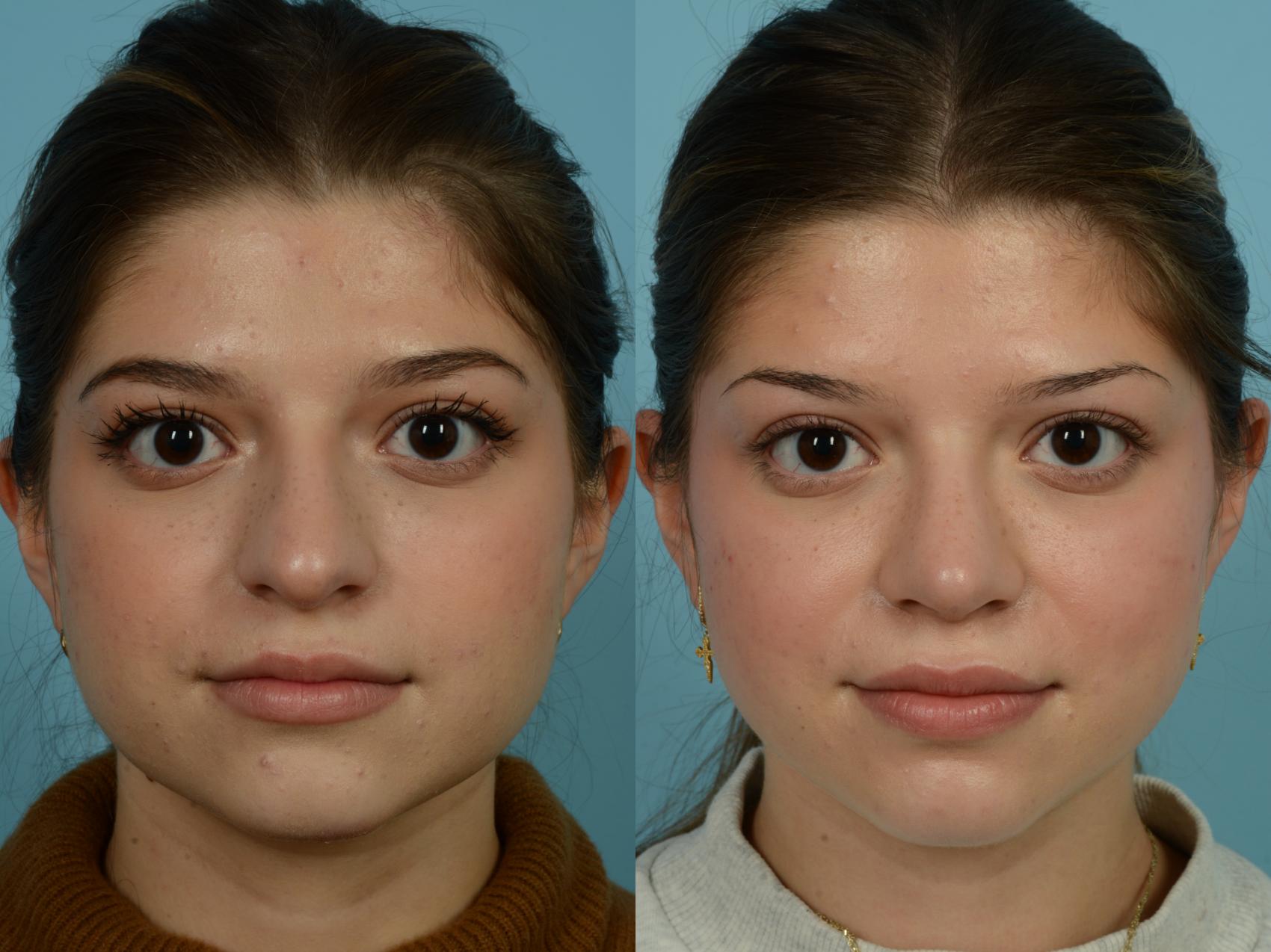 Rhinoplasty By Dr Sinno Before And After Pictures Case 872 Chicago Il Tlkm Plastic Surgery 