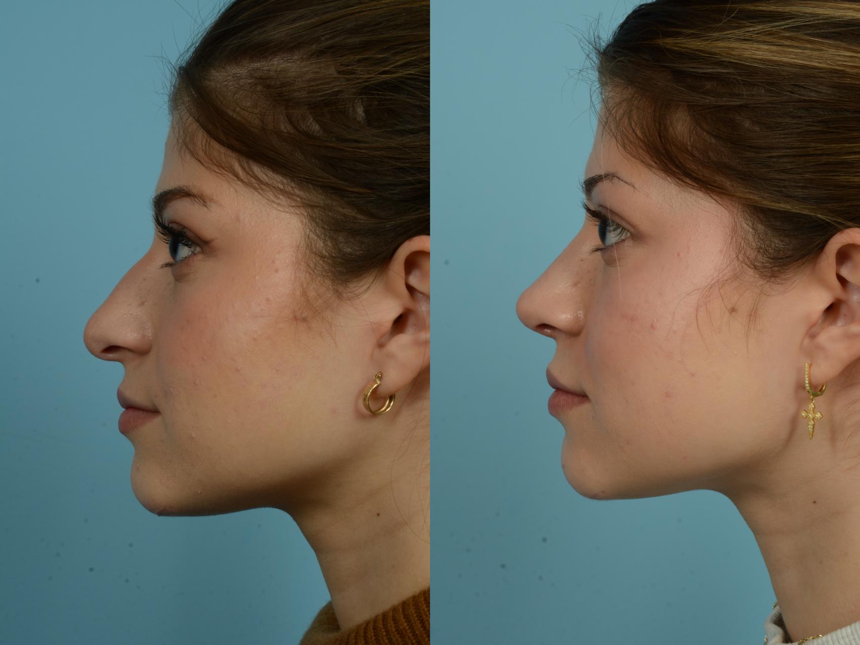 Before & After Rhinoplasty by Dr. Sinno Case 872 Left Side View in Chicago, IL