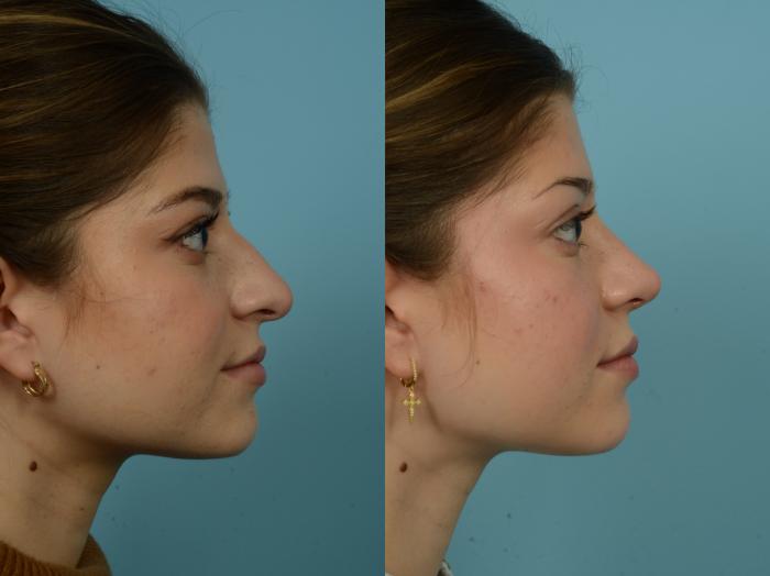 Before & After Rhinoplasty by Dr. Sinno Case 872 Right Side View in Chicago, IL