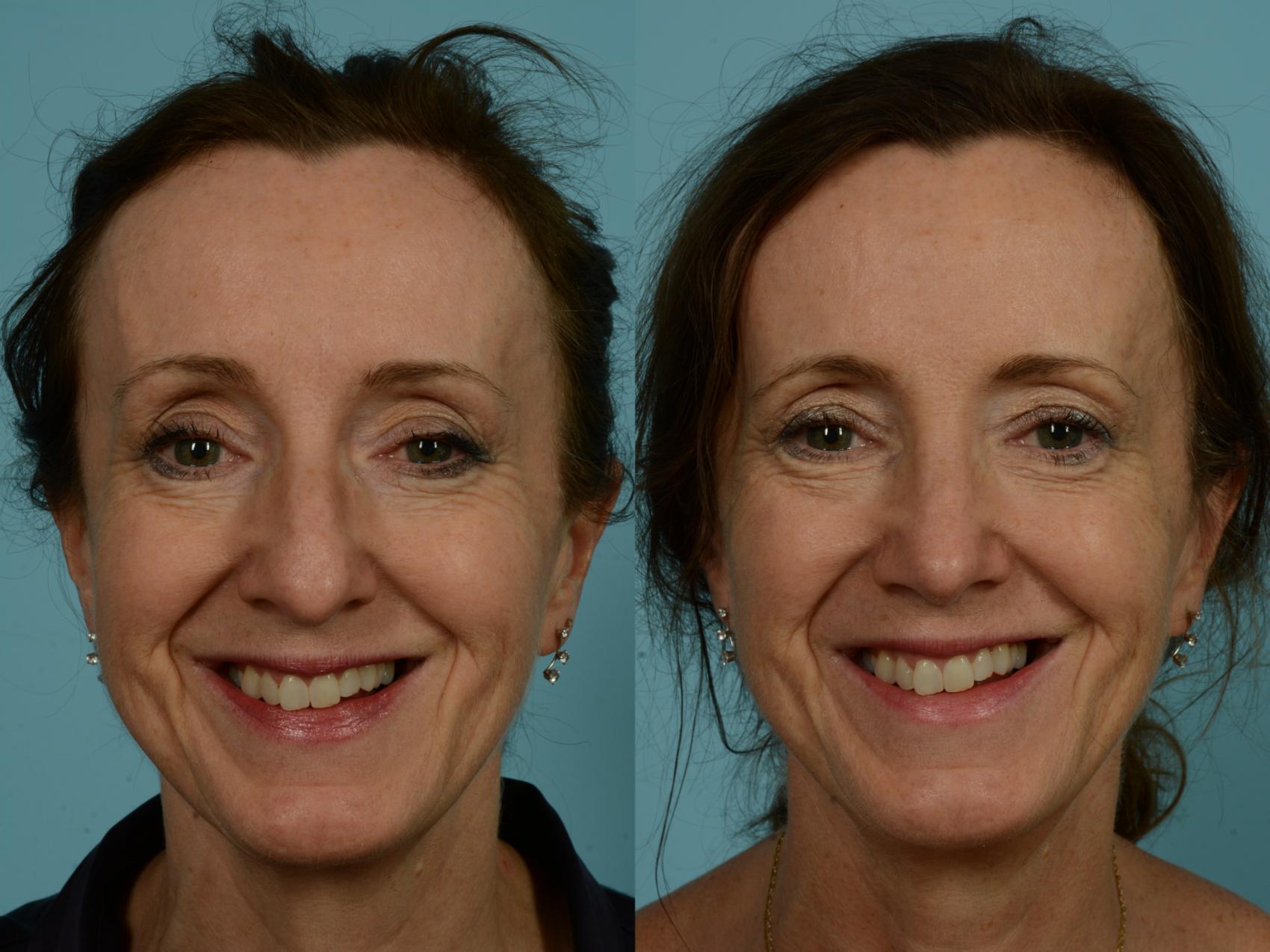 Before & After Rhinoplasty by Dr. Sinno Case 873 Front View in Chicago, IL