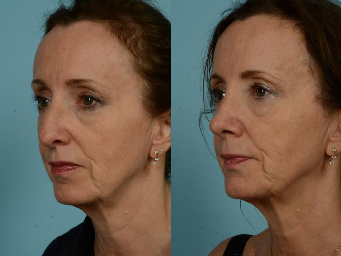 Before & After Rhinoplasty by Dr. Sinno Case 873 Left Oblique View in Chicago, IL