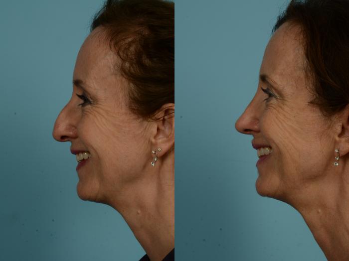 Before & After Rhinoplasty by Dr. Sinno Case 873 Left Side View in Chicago, IL