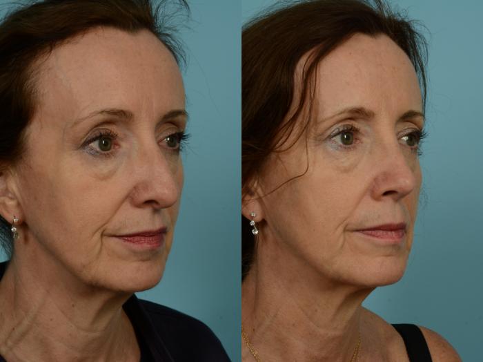 Before & After Rhinoplasty by Dr. Sinno Case 873 Right Oblique View in Chicago, IL