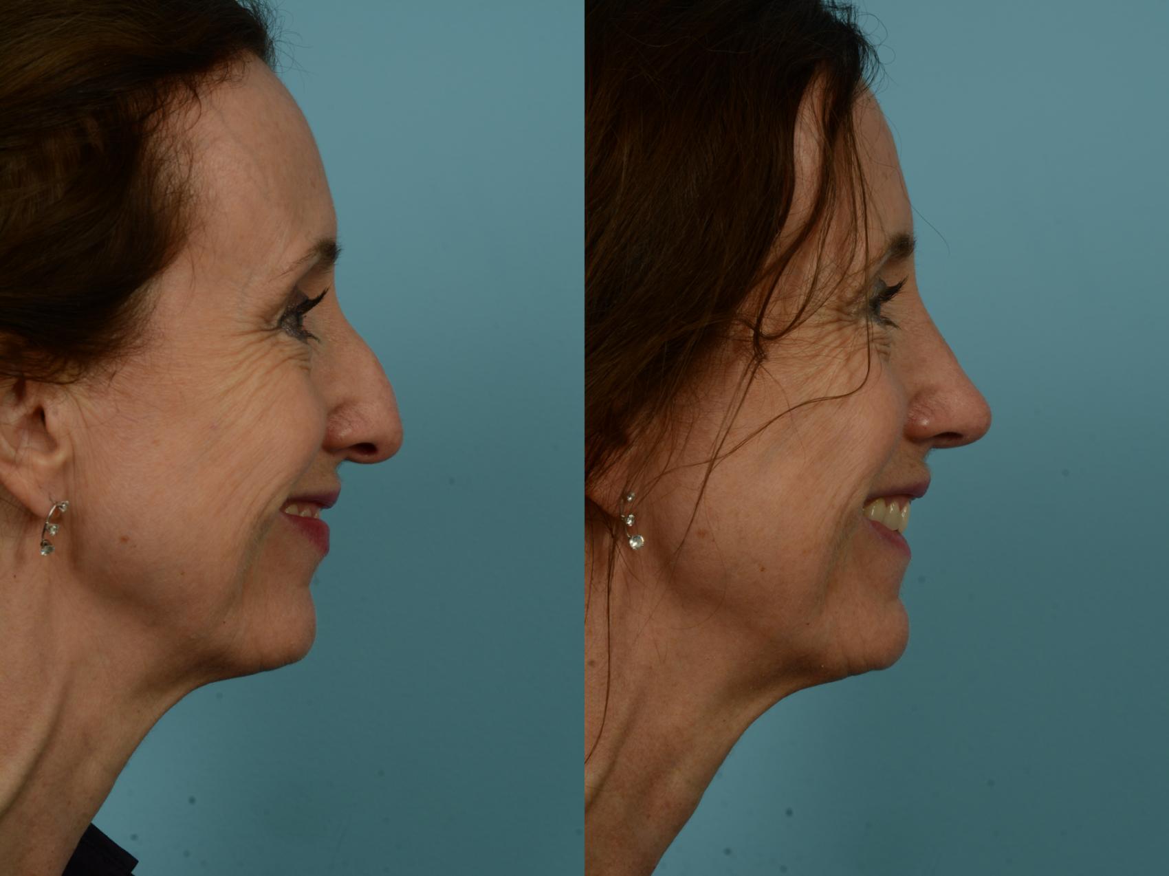 Before & After Rhinoplasty by Dr. Sinno Case 873 Right Side View in Chicago, IL