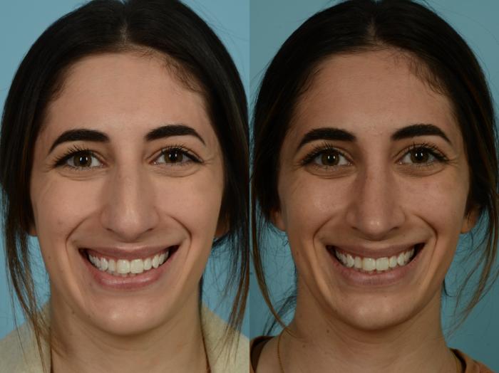 Before & After Rhinoplasty by Dr. Sinno Case 875 Front View in Chicago, IL