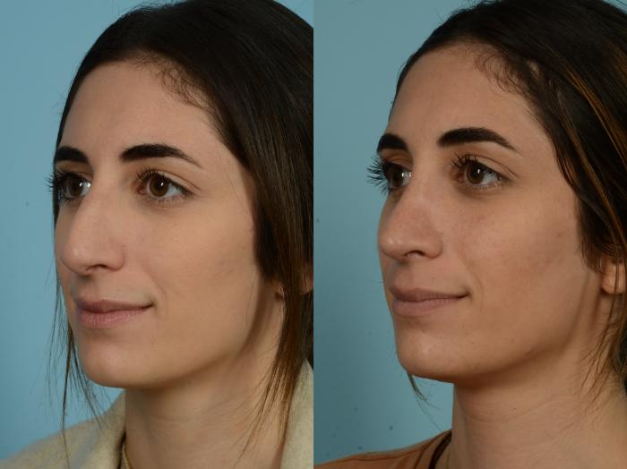 Before & After Rhinoplasty by Dr. Sinno Case 875 Left Oblique View in Chicago, IL