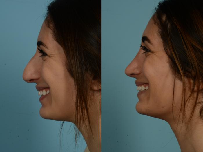 Before & After Rhinoplasty by Dr. Sinno Case 875 Left Side View in Chicago, IL