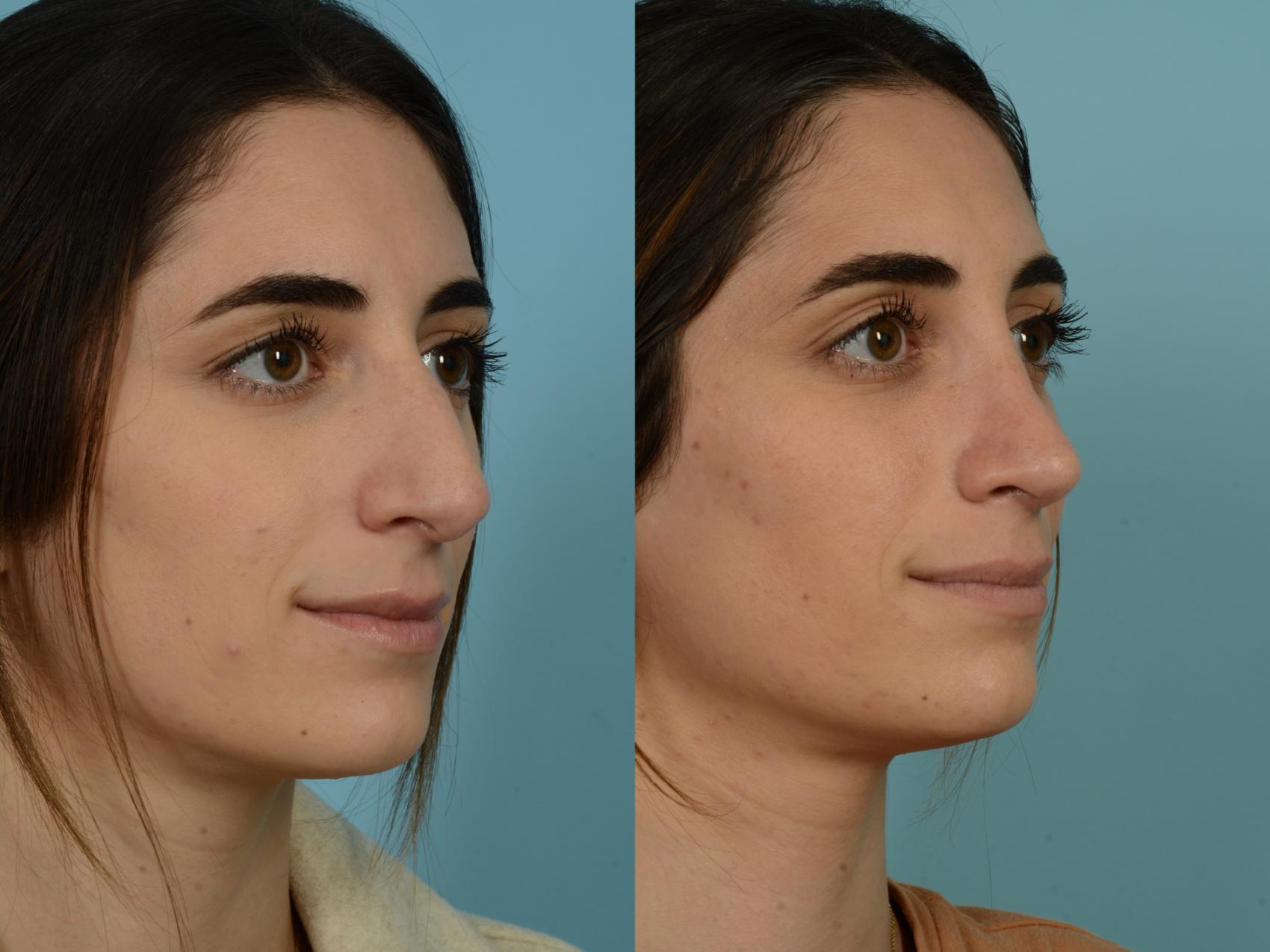 Before & After Rhinoplasty by Dr. Sinno Case 875 Right Oblique View in Chicago, IL