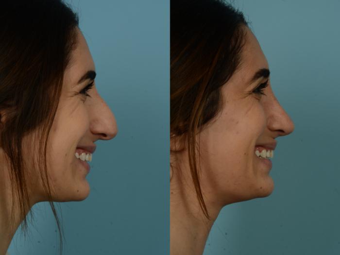 Before & After Rhinoplasty by Dr. Sinno Case 875 Right Side View in Chicago, IL