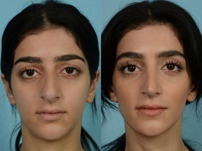 Before & After Rhinoplasty by Dr. Sinno Case 878 Front View in Chicago, IL