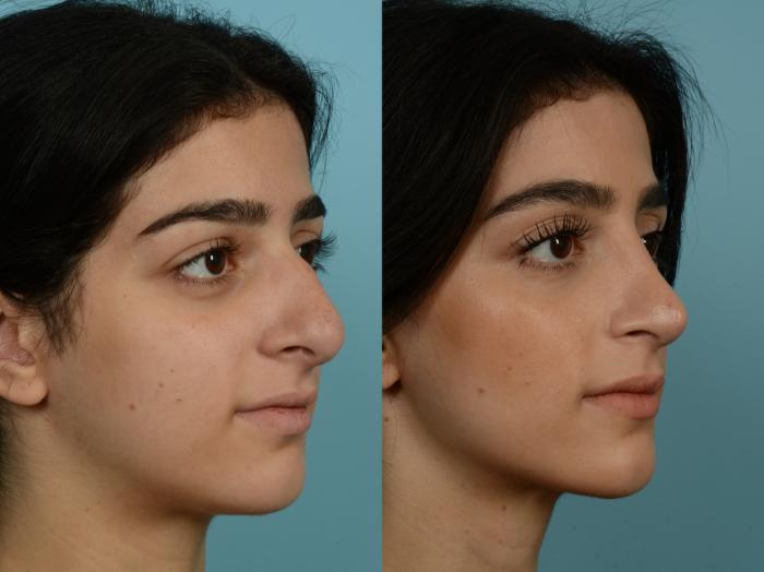 Before & After Rhinoplasty by Dr. Sinno Case 878 Right Oblique View in Chicago, IL