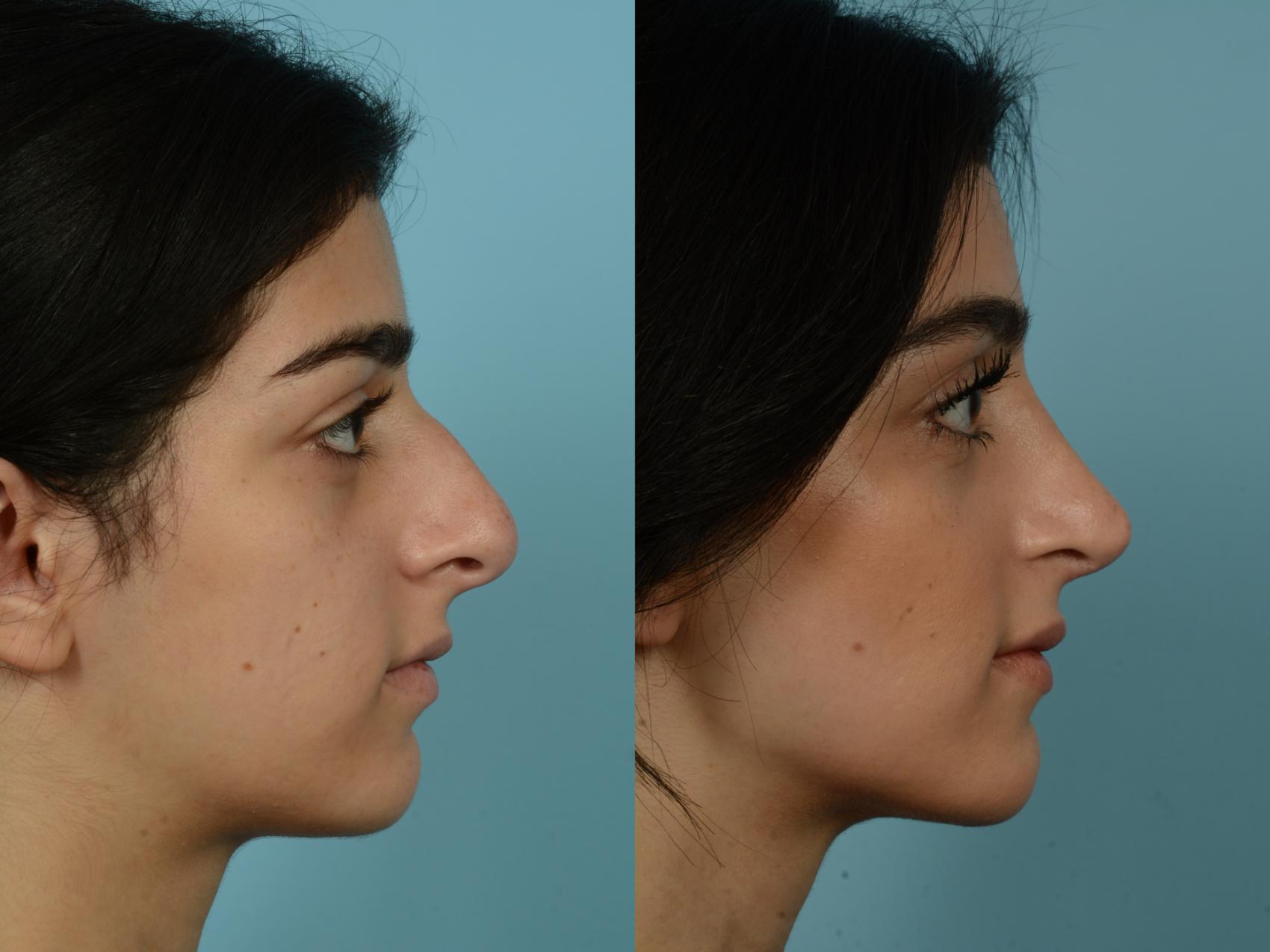 Before & After Rhinoplasty by Dr. Sinno Case 878 Right Side View in Chicago, IL