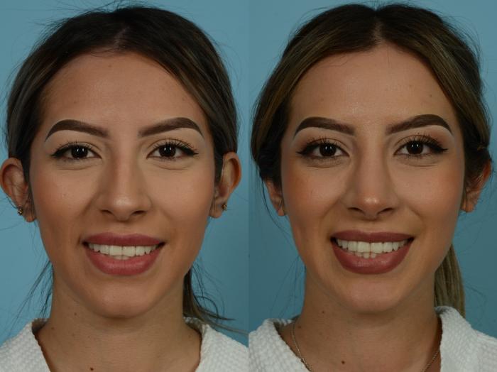 Before & After Rhinoplasty by Dr. Sinno Case 879 Front View in Chicago, IL