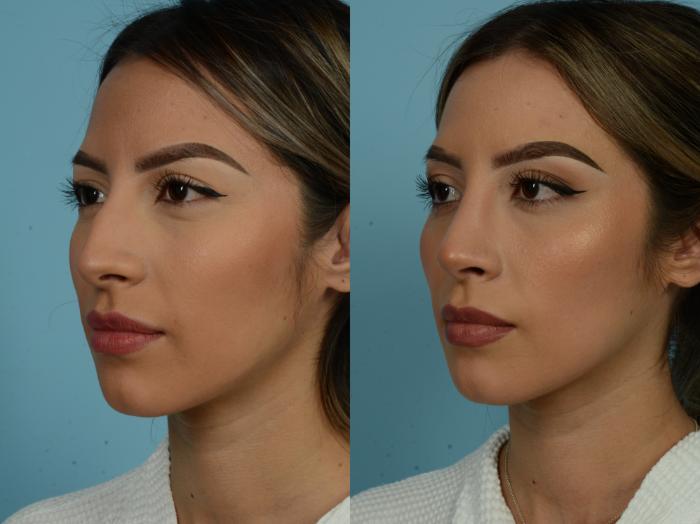 Before & After Rhinoplasty by Dr. Sinno Case 879 Left Oblique View in Chicago, IL