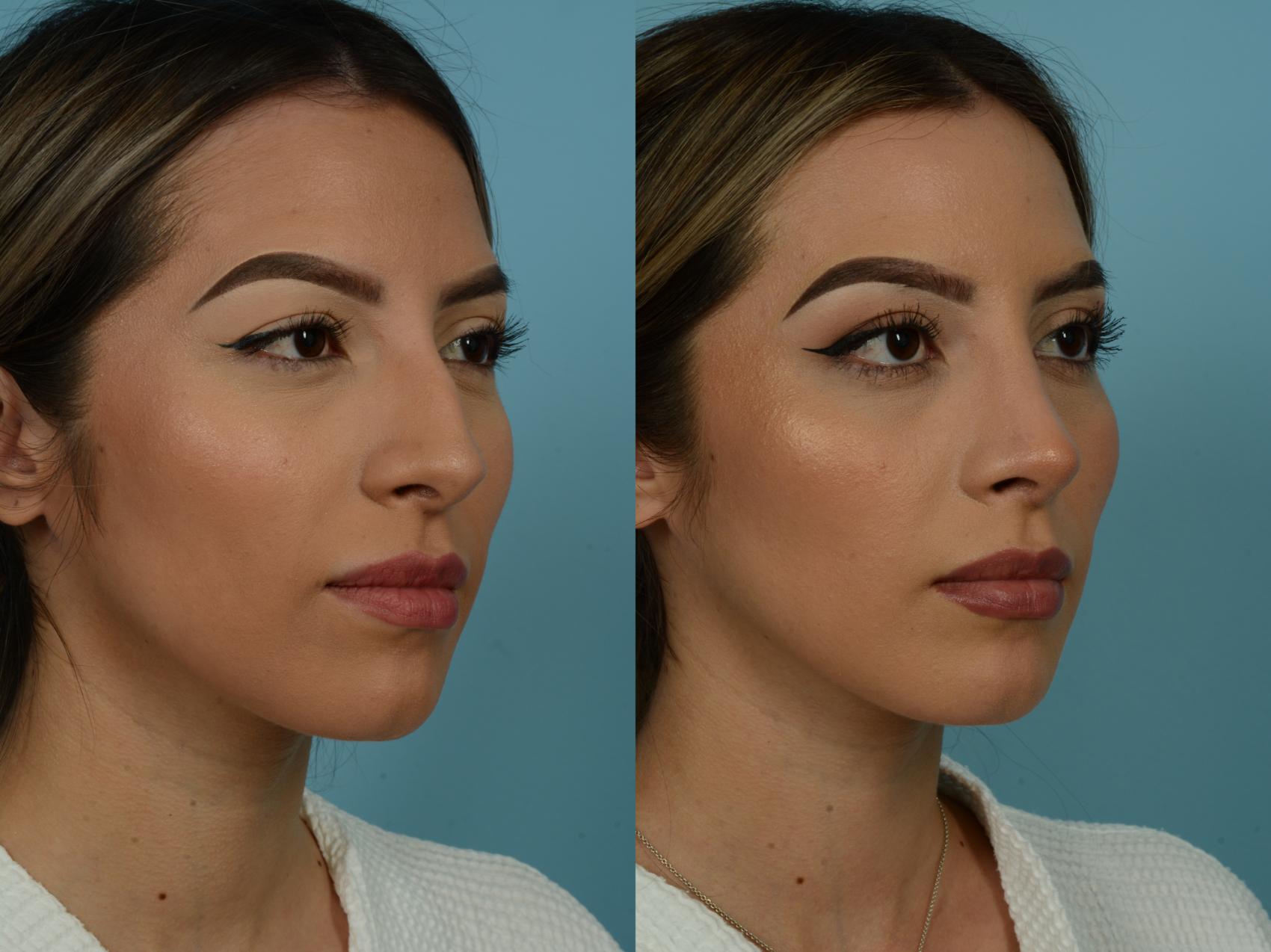 Before & After Rhinoplasty by Dr. Sinno Case 879 Right Oblique View in Chicago, IL