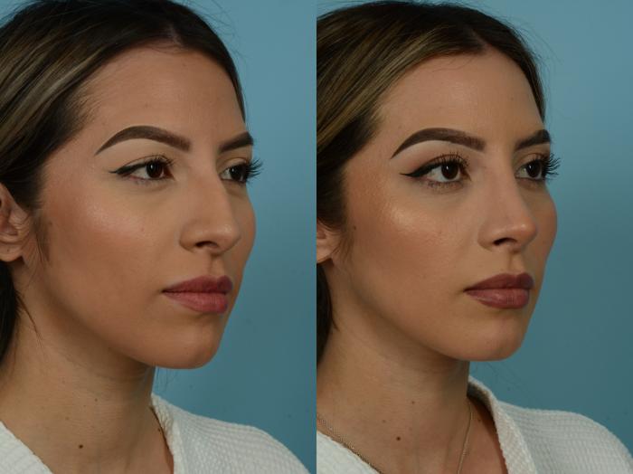 Before & After Rhinoplasty by Dr. Sinno Case 879 Right Oblique View in Chicago, IL