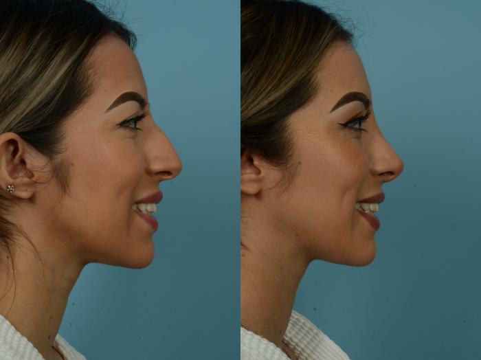 Before & After Rhinoplasty by Dr. Sinno Case 879 Right Side View in Chicago, IL