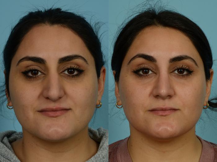 Before & After Rhinoplasty by Dr. Sinno Case 881 Front View in Chicago, IL