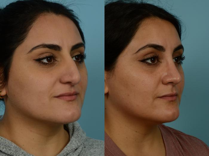 Before & After Rhinoplasty by Dr. Sinno Case 881 Right Oblique View in Chicago, IL