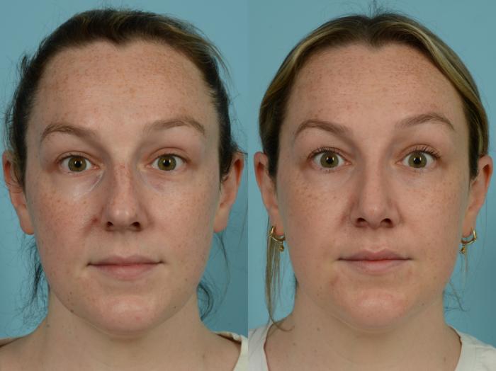 Before & After Rhinoplasty by Dr. Sinno Case 882 Front View in Chicago, IL