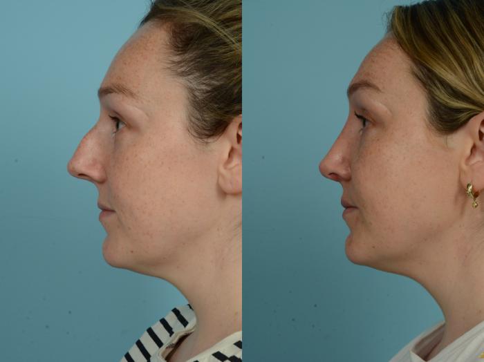 Before & After Rhinoplasty by Dr. Sinno Case 882 Left Side View in Chicago, IL