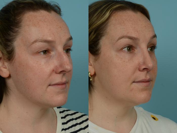 Before & After Rhinoplasty by Dr. Sinno Case 882 Right Oblique View in Chicago, IL