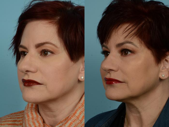 Before & After Rhinoplasty by Dr. Sinno Case 883 Left Oblique View in Chicago, IL