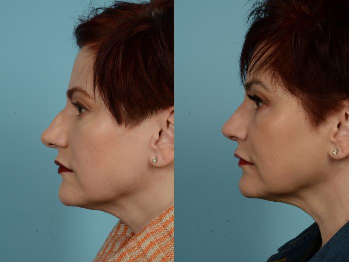 Before & After Rhinoplasty by Dr. Sinno Case 883 Left Side View in Chicago, IL