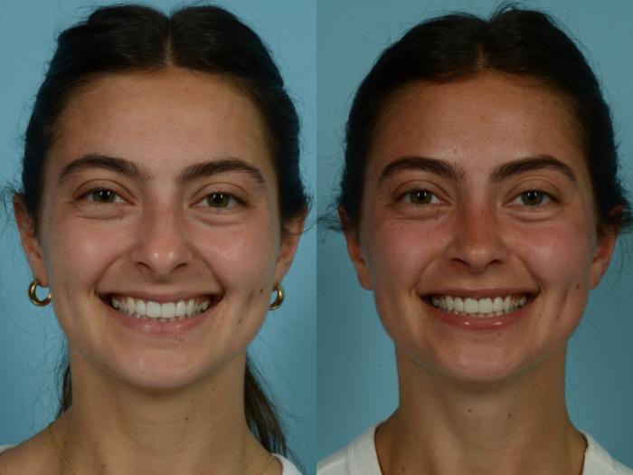 Before & After Rhinoplasty by Dr. Sinno Case 884 Front View in Chicago, IL