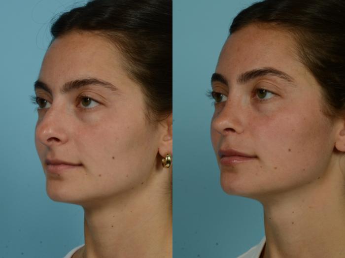 Before & After Rhinoplasty by Dr. Sinno Case 884 Left Oblique View in Chicago, IL