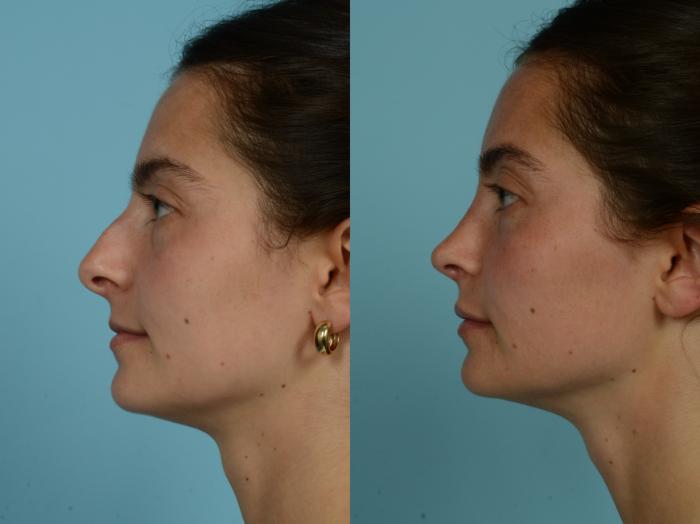 Before & After Rhinoplasty by Dr. Sinno Case 884 Left Side View in Chicago, IL