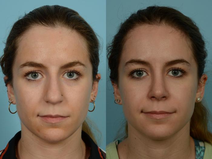 Before & After Rhinoplasty by Dr. Sinno Case 886 Front View in Chicago, IL