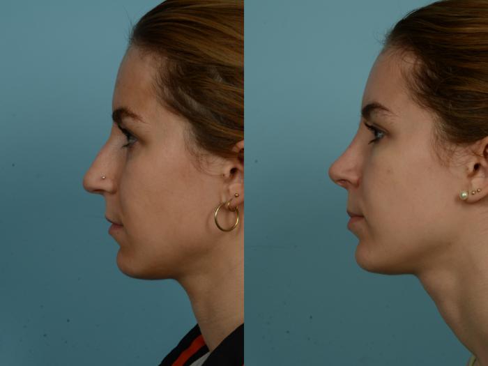 Before & After Rhinoplasty by Dr. Sinno Case 886 Left Side View in Chicago, IL