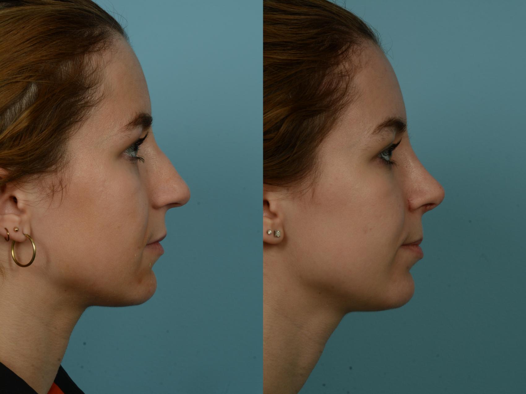Before & After Rhinoplasty by Dr. Sinno Case 886 Right Side View in Chicago, IL