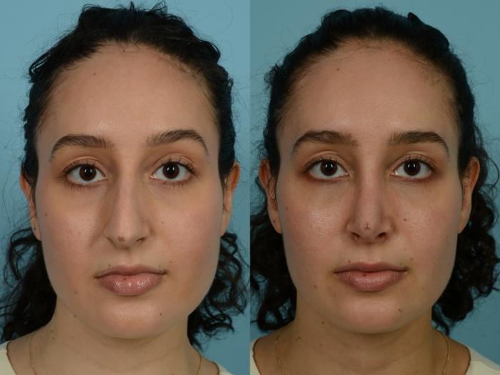 Before & After Rhinoplasty by Dr. Sinno Case 891 Front View in Chicago, IL