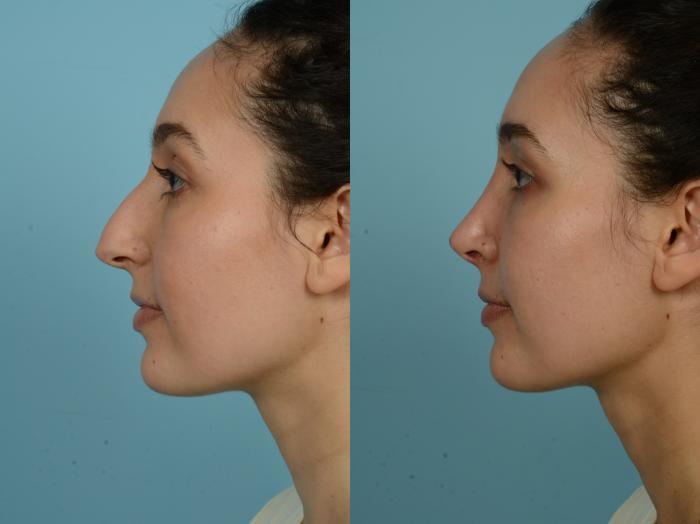 Before & After Rhinoplasty by Dr. Sinno Case 891 Left Side View in Chicago, IL
