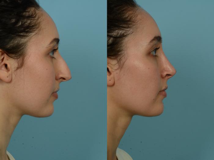 Before & After Rhinoplasty by Dr. Sinno Case 891 Right Side View in Chicago, IL
